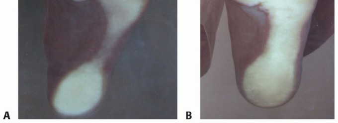 Illustration 7 for Plantar Plate Repair: End Lesser Toe Pain & Instability
