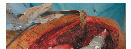 Illustration 10 for Limb Salvage: New Advances in Proximal Femoral Replacement