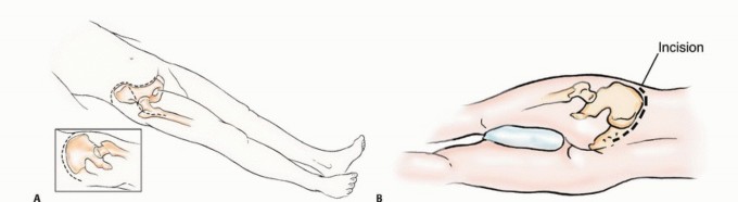 Illustration 14 for Pelvic Metastasis Surgery: A Component of the Utilitarian Approach
