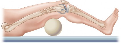 Illustration 14 for Mastering Periprosthetic Femoral Fractures Above Knee Arthroplasty