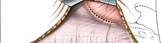 Illustration 11 for Pelvis & Acetabulum Approaches: Unlocking the Posterior Superior Iliac