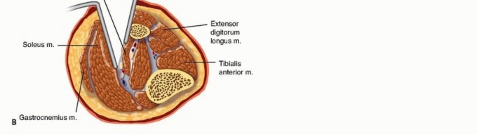 Illustration 21 for Acute Compartment Syndrome: Timely Fasciotomy Explained