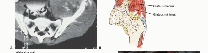 Illustration 16 for Pelvic Metastasis Surgery: A Component of the Utilitarian Approach