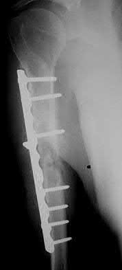 Illustration 90 for OrthoCash: Trauma MCQs & Cases for a yearold woman