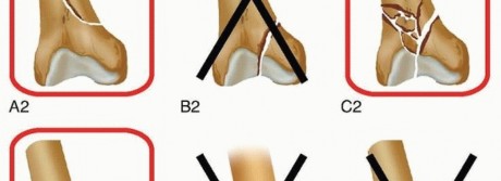 Illustration 11 for Retrograde Femoral Nailing: Optimizing Surgical Outcomes