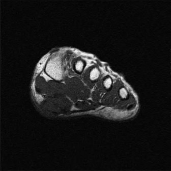 Illustration 3 for Foot Nodule Pain? Solutions for Masses along the Medial Cord