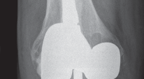 Illustration 20 for Porous Metal Cones: Biologic Fixation for Severe Bone Loss