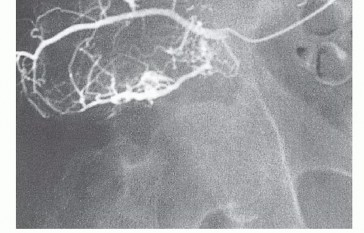 Illustration 7 for Surgical Pelvic Resection: Gluteus Maximus Muscle & Nerve Preservation