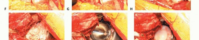 Illustration 18 for Revision Arthroplasty with Acetabular Bone Loss: The Antiprotrusio Cage