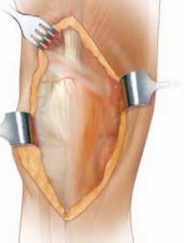 Illustration of exposure vy quadroplasty - Dr. Mohammed Hutaif