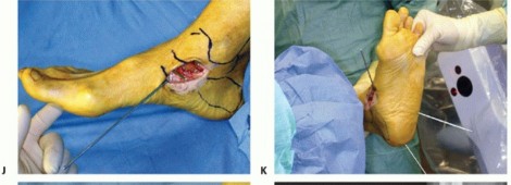 Illustration 62 for Medial Ankle Instability: Find Relief with Reconstruction