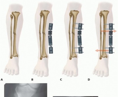 Illustration 34 for Tibia External Fixation: See How Pins Are Placed for Healing