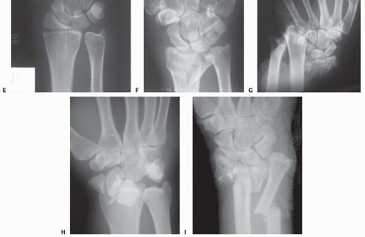 Illustration 7 for Fragment-Specific Fixation: Restore Carpal Facet Horizon
