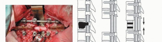 Illustration 30 for Total En Bloc Spondylectomy: Complete Resection for Spinal Tumors