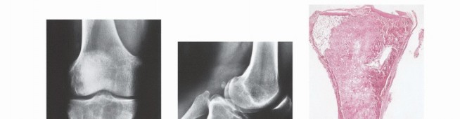 Illustration 47 for Understanding Benign Bone Tumors: Your Complete Preoperative Guide