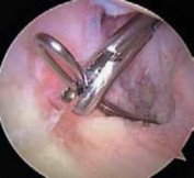 Illustration 13 for Cruciate Ligament Repair: Definitive Guide to Treatment & Recovery