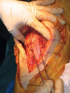 Illustration 5 for Extensor Reconstruction in Total Knee Arthroplasty: Essential Strategies