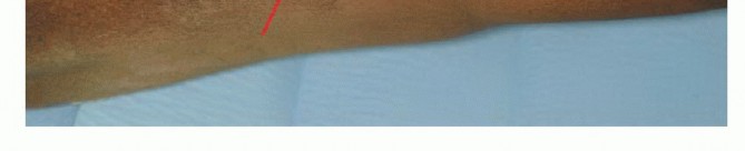 Illustration 10 for Advanced Distal Femoral Resections: Limb-Sparing Outcomes & Techniques