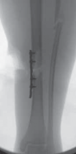 Illustration 42 for Optimal Nailing of the Tibia: Techniques for Challenging Fractures