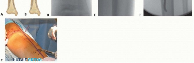 Illustration 13 for Optimal Treatment for Pediatric Tibial Fractures: Key Insights