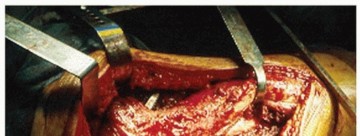 Illustration 31 for Sliding Trochanteric Osteotomy: Modern Role & Refined Techniques