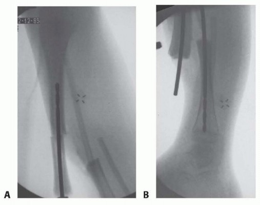 Illustration 7 for Williams Rod: Achieve Stability for Pseudarthrosis within the Tibia