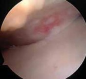 Illustration 9 for Regain Stability: Anterior Shoulder Instability Arthroscopic Fix