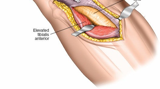 Illustration 14 for Surgical Access: Mastering the Tibia's Surface & Fibula Approaches