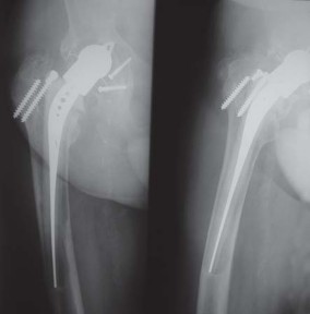 Illustration 74 for S-ROM: Inside the Technique of Modular Implant Design