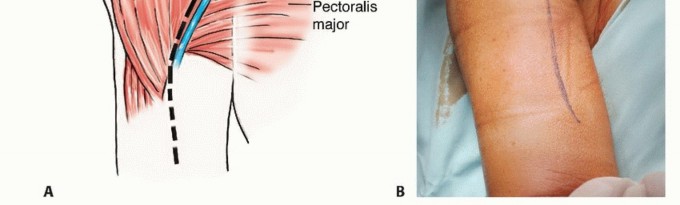 Illustration 7 for Restore Vital Function: Surgery for Type II Humeral Metastasis
