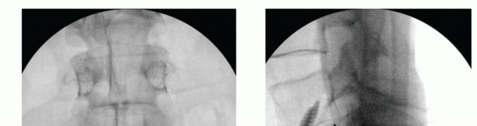 Illustration 12 for Anterior Lumbar Interbody: Fusion, Disc Replacement & Pain Relief