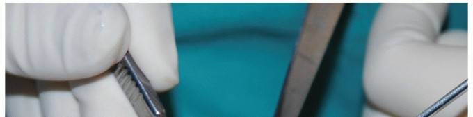 Illustration 13 for MTP Joint Arthrodesis: The Key to Optimal Toe Positioning