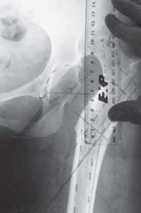 Illustration 28 for Successful Total Hip Replacement in Developmental Dysplasia