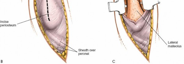 Illustration 85 for Optimized Approaches to the Dorsum of the Foot & Ankle