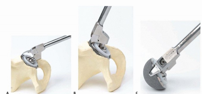 Illustration 9 for Well-Fixed THA Revisions: Precision in the Portion of the Osteotomy
