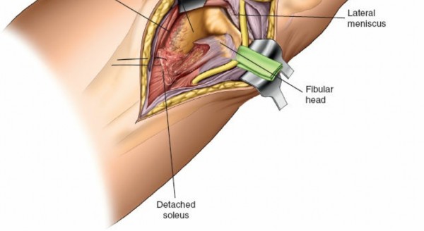 Illustration 35 for Surgical Access: Mastering the Tibia's Surface & Fibula Approaches
