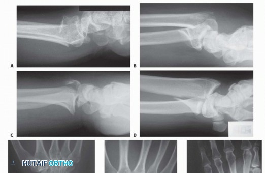 Illustration 6 for Fragment-Specific Fixation: Restore Carpal Facet Horizon
