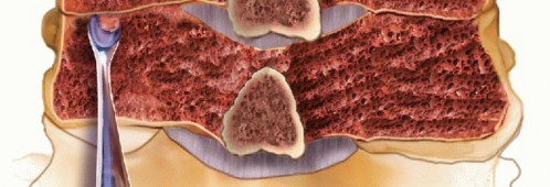 Illustration 4 for Achieve Stability: Posterior Cervical Lateral Mass Screw Fusion