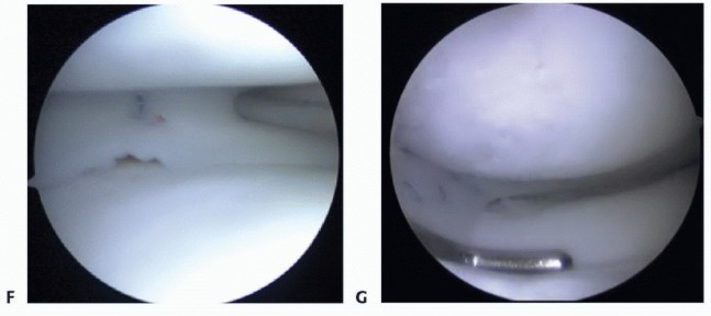 Illustration 20 for Symptomatic Knee? Meniscal Transplant for Anterior & Posterior Horns