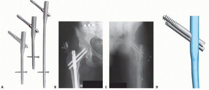 Illustration 10 for Achieve Optimal Femoral Head Fixation with Cephalomedullary Nailing