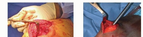 Illustration 21 for Optimizing Intramedullary Nailing for Tibial Shaft Fractures