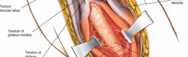 Illustration 56 for Unlocking Every Aspect of the Hip's Surgical Approaches