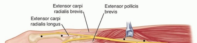 Effective K-Wire Fixation: Distal Radius Fractures Without External Fixation