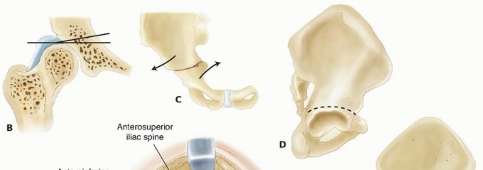 Chiari Medial Displacement: Relief for Unstable & Painful Hips