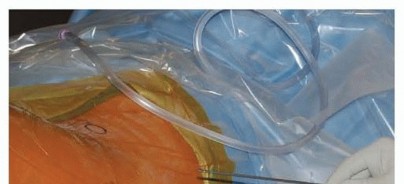 Illustration 13 for Achieve Optimal Femoral Head Fixation with Cephalomedullary Nailing