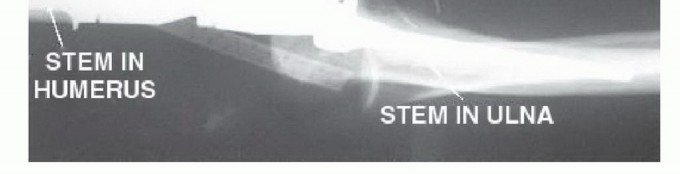 Illustration 29 for Distal Humeral Resection: Safe Techniques for Limb Preservation
