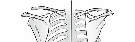 Scapulothoracic Dissociation: A Guide to This Rare Scapulothoracic Injury