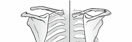 صورة توضيحية لـ تفكك لوح الكتف عن القفص الصدري: دليل شامل للمريض نحو الشفاء بإشراف د. محمد هطيف