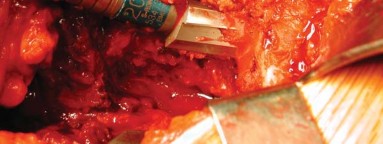 Illustration 17 for S-ROM: Inside the Technique of Modular Implant Design