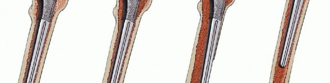 Illustration 3 for Exeter Hip Unit: Mastering Impaction Allografting for Femoral Bone Loss